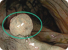 ポリープを発見