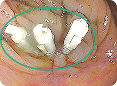 大腸 ポリープ クリップ 大き さ